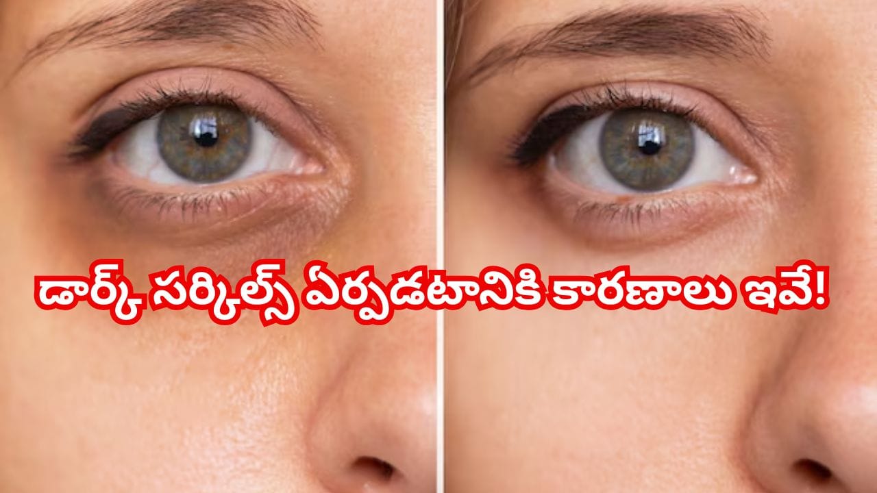 కళ్ల అందాన్ని తగ్గిస్తున్న డార్క్ సర్కిల్స్ – ఎందుకు వస్తాయంటే? కళ్ల అందాన్ని తగ్గిస్తున్న డార్క్ సర్కిల్స్ – ఎందుకు వస్తాయంటే?