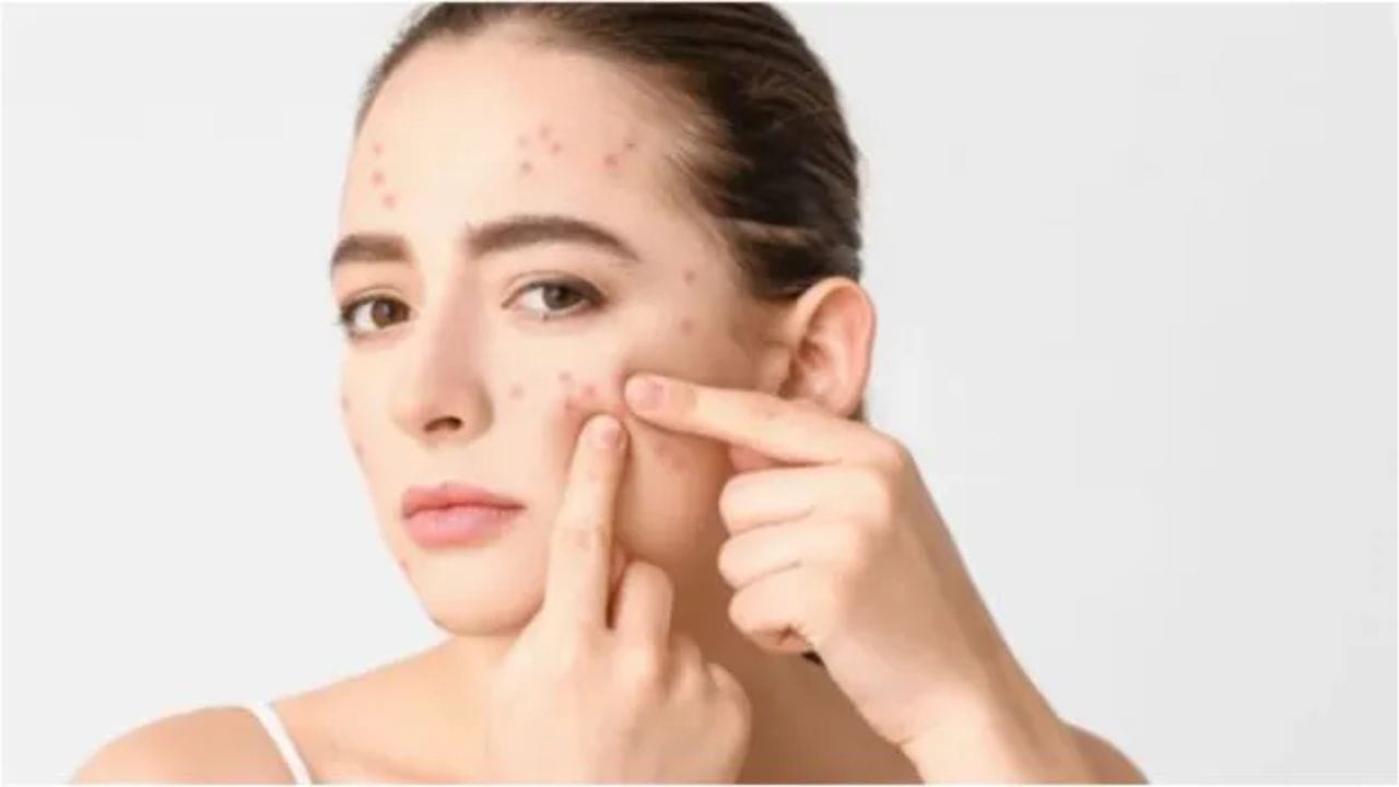 Face Pimples: ఏం చేసినా మొటిమలు తగ్గకపోగా , తరచూ వస్తున్నాయా.. కారణం ఇదేనేమో