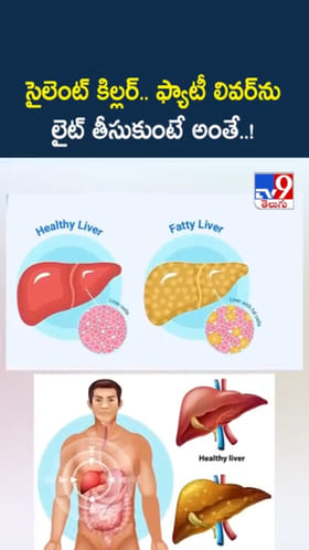 సైలెంట్‌ కిల్లర్‌.. Fatty Liverను లైట్ తీసుకుంటే అంతే..!