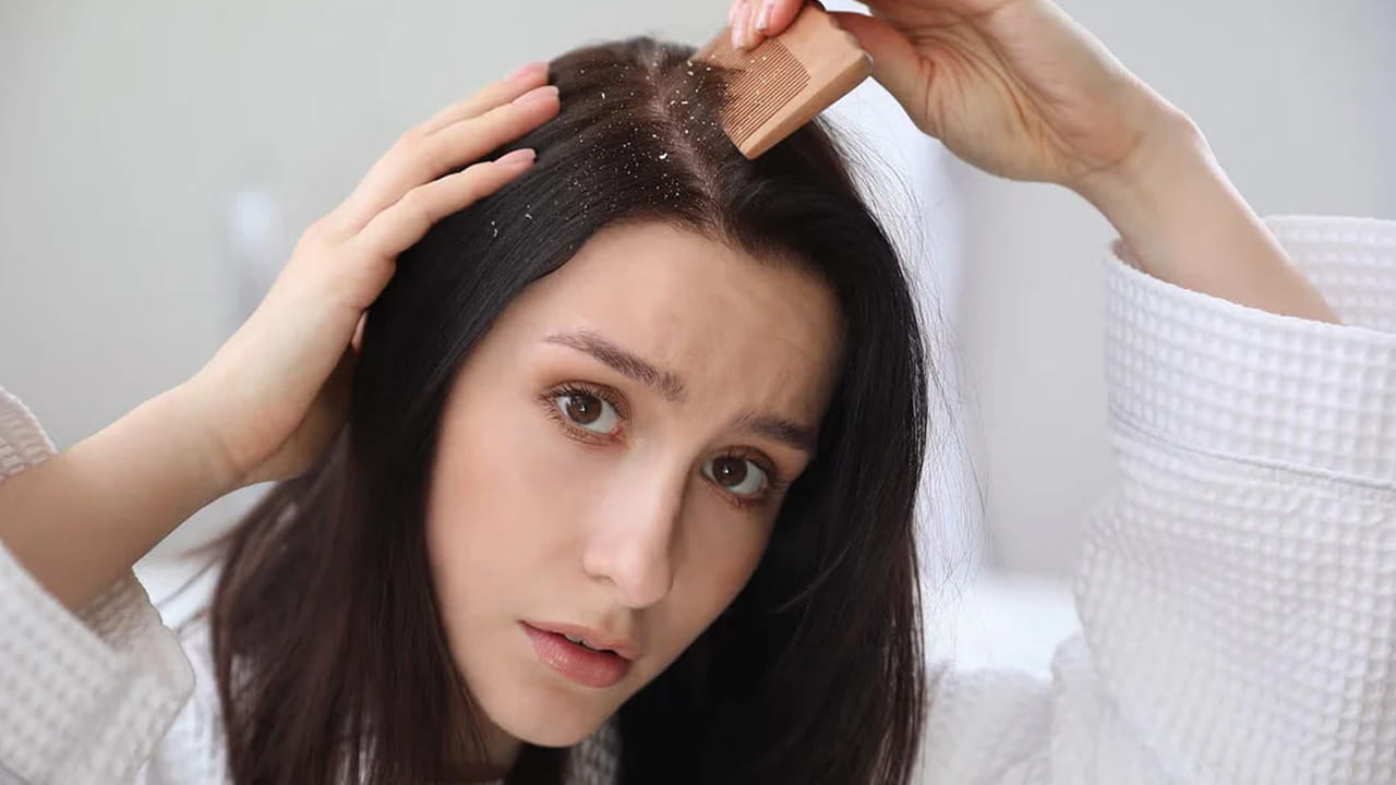 చేపలు: చుండ్రు సమస్య  తగ్గించడంలో చేపలు కీలక పాత్ర వహిస్తాయి. అయితే, ఈ విషయం చాలా మందికి తెలియదు. అయితే, సాల్మన్ వంటి చేపలను తీసుకుంటే జుట్టు కూడా బాలంగా ఉంటుంది.