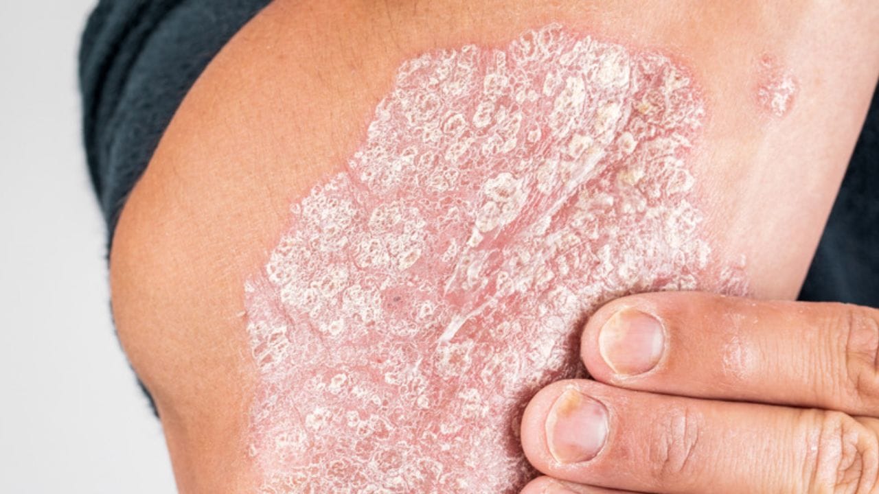 చర్మంపై దురద లేదా పొడిబారడం: మీ చర్మం అకస్మాత్తుగా దురదగా మారడం లేదా చర్మంపై పొడిబారిన మచ్చలు కనిపిస్తే అది ఫ్యాటీ లివర్‌కు సంకేతం కావచ్చు. అయితే ఇది కచ్చితంగా కాలేయ వ్యాధిని నిర్ధారించకపోయినప్పటికీ.. మీ చర్మంపై ఇలాంటి మార్పులు కనిపిస్తే రక్త పరీక్షల ద్వారా మీరు దానిని కనుగొనవచ్చు. ఇంటర్నేషనల్ జర్నల్ ఆఫ్ ఫార్మాస్యూటికల్ సైన్సెస్ (2025) ప్రకారం.. NAFLD పురోగతి పైత్య జీవక్రియను దెబ్బతీస్తుంది.. దీని వలన దురద, చర్మసంబంధమైన లక్షణాలు వస్తాయని తేలింది.