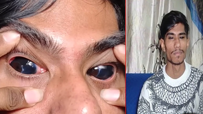 ఐ బాల్ టాటూ... నిజంగా నిన్ను చూస్తుంటే జాలి వేస్తుంది బ్రదర్..