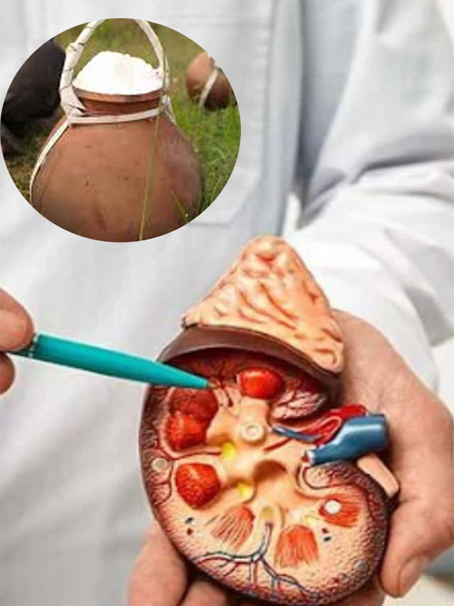 తెలుసుకోండి.. కిడ్నీ రాళ్లకు తాటి కల్లు చెక్ పెడుతుందా?