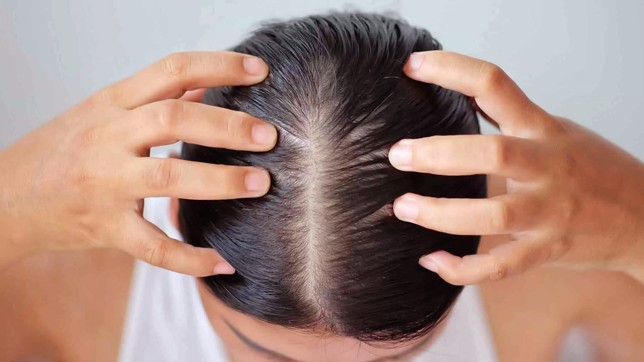 వేప నూనె: మీరు రోజూ వాడే కొబ్బరి నూనెలో పది చుక్కలు వేప నూనె వేసి తలకు బాగా పట్టించి 1 గంట తర్వాత తలస్నానం చేయండి. ఇలా చేస్తే పేలు మొత్తం వదులుతాయి. వారానికొకసారి ఇలా చేస్తే మంచి ఫలితం ఉంటుంది.