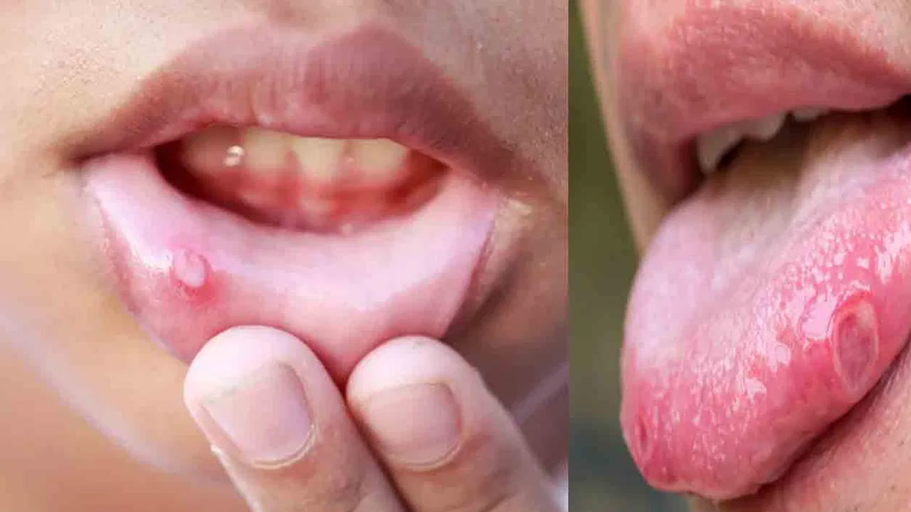 కాబట్టి, నోటి పూతలు వచ్చినప్పుడు సరైన చికిత్స తీసుకోవడం చాలా అవసరం. అసలు ఈ నోటి పూతలు ఎందుకు వస్తాయో ఇక్కడ వివరంగా తెలుసుకుందాం..