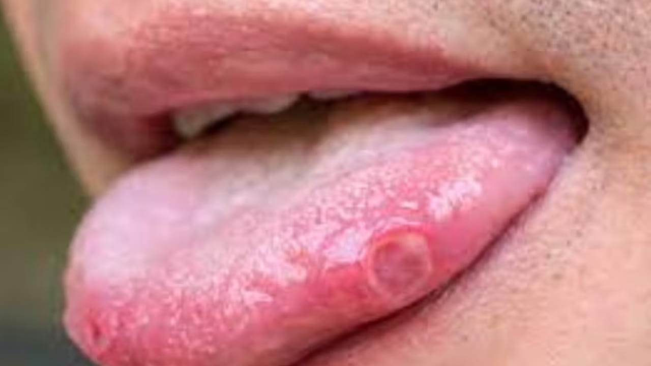 శరీరంలో ఐరన్ లోపం కానీ, జీర్ణ సమస్యలు ఉన్నప్పుడు కానీ ఇలా నోటి పూతలు వస్తాయి. ఒక్కోసారి ఎక్కువ స్పైసీ ఉన్న ఫుడ్స్ తీసుకున్నా నోటిపూతలు వస్తాయి.