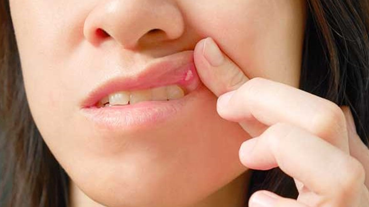 నోటి పూత వస్తే ఏ ఫుడ్స్ కూడా తినలేము. అలాగే, ఒక్కోసారి అయితే మంచి నీళ్లు కూడా తాగలేము. సాధారణంగా ఇవి మన శరీరంలో ఇతర లోపాలు ఉన్నప్పుడు ఇలా వస్తాయి. నెలలో మూడు నాలుగు సార్లు ఇలాగే వస్తే దానిని తేలికగా వదిలేయొద్దు.