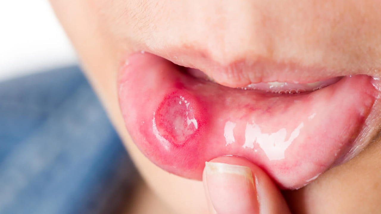 క్యాన్సర్ ప్రారంభ లక్షణాలు :నోటి క్యాన్సర్ ప్రారంభ లక్షణాలు చిన్న పుండులా ప్రారంభం అవుతుందంట. మొదట పెదవి చిగుళ్లలో చిన్న పుండు ఏర్పడటం ఇది అలాగే కొనసాగుతూ, నాలుక, బుగ్గల లోపలికి వ్యాపిస్తుందంట. కొన్ని సార్లు దవడ భాగంలో పుండులా ఏర్పడుతుందంట.