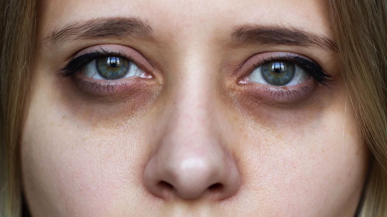 Redness Of The Cheeks (1)