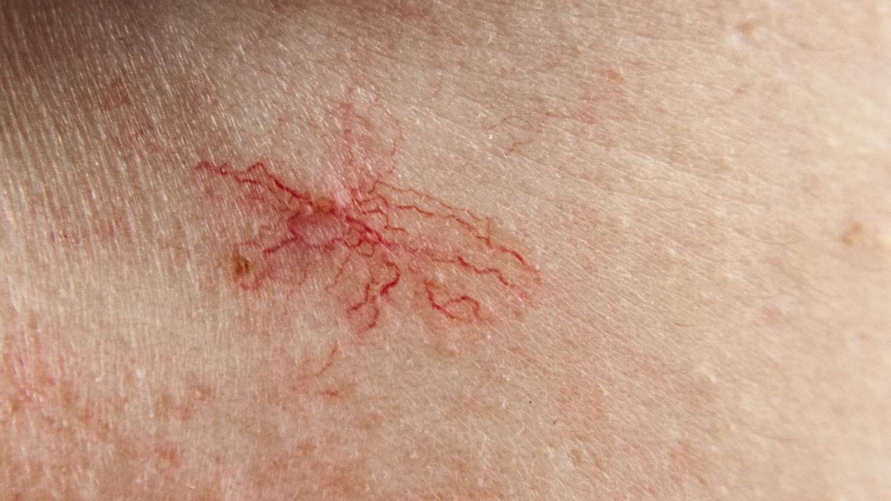 స్పైడర్ ఆంజియోమాస్: మీ చర్మంపై చిన్న ఎరుపు రంగు మచ్చలు కనిపించడాన్ని స్పైడర్ ఆంజియోమాస్ అంటారు. ఇవి సాలీడు ఆకారంలో, మధ్యలో ఎర్రటి చుక్క ఉండి చుట్టూ కాళ్లలాంటి రక్తనాళాల విస్తరణతో ఉంటాయి అందుకే దీనిని స్పైడర్ ఆంజియోమాస్ అంటారు. ఇవి తరచుగా కాలేయ వ్యాధులు, గర్భధారణ, లేదా హార్మోన్ల మార్పుల వల్ల ఏర్పడతాయి. మీ ముఖం, మెడ లేదా ఛాతీపై స్పైడర్ ఆంజియోమాలు కనిపిస్తే మీరు వెంటనే వైద్యుడిని సంప్రదించాలి.  