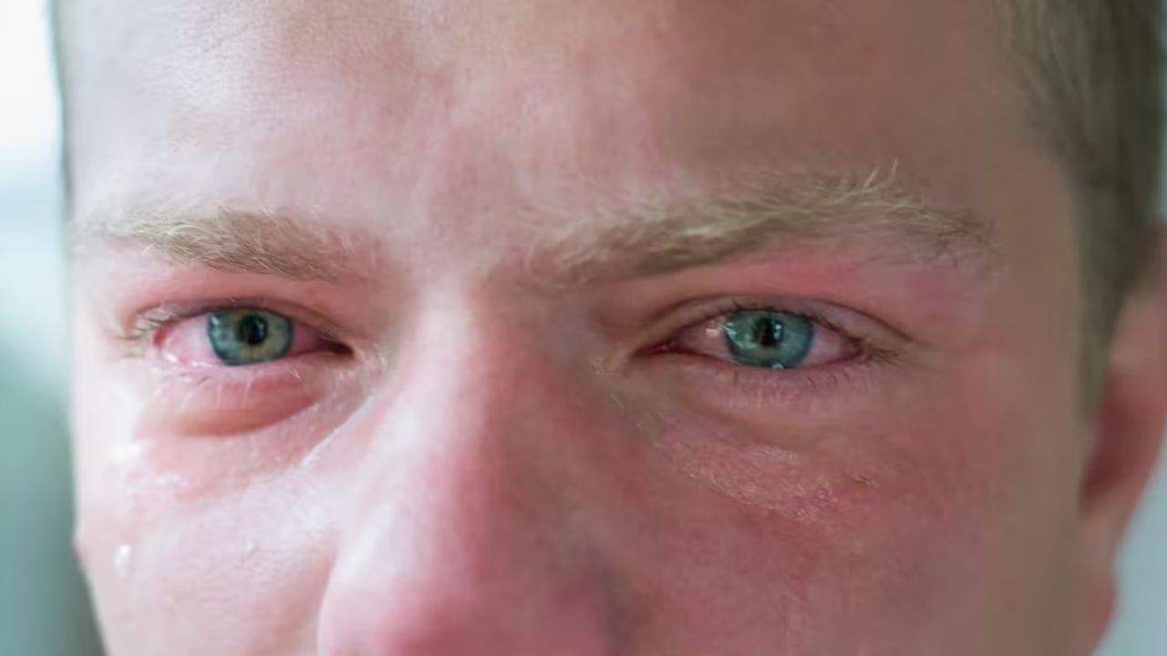 కళ్ళు లేదా ముఖం చుట్టూ వాపు: మీ కాలేయ పనితీరు బలహీన పడినప్పుడు మీ కళ్లు లేదా ముఖంలో మార్పులు రావచ్చు. కాబట్టి, మీ కళ్ళు లేదా ముఖం చుట్టూ వాపు లేదా ఉబ్బరంగా అనిపిస్తే వెంటనే వైద్యులను సంప్రదించండి. ఈ సమస్యకు పరిష్కరించుకోవడానికి మీరు వెంటనే చికిత్స తీసుకోవడం చాలా ముఖ్యం. జర్నల్ ఆఫ్ హెపటాలజీ (2025) ప్రకారం.. ఫ్యాటీ లివర్ వ్యాధి ముదిరినప్పుడు, అది హైపోఅల్బ్యూమినేమియాకు దారితీస్తుంది, ఇది కాలేయ ప్రోటీన్ సంశ్లేషణ బలహీనపడటం వల్ల జరుగుతుంది. 