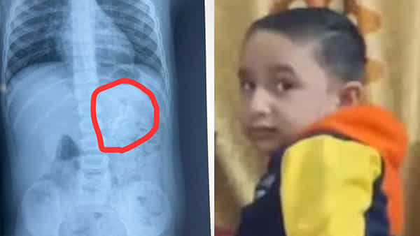 Viral: ఎంత పని చేశావ్ హల్క్.! ఆడుకుంటుండగా నోట్లోంచి రాని మాట.. ఎక్స్రే తీసి కంగుతిన్న డాక్టర్లు