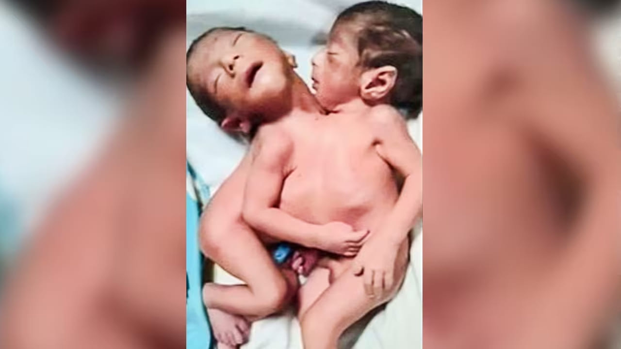 Aligarh Conjoined Twins