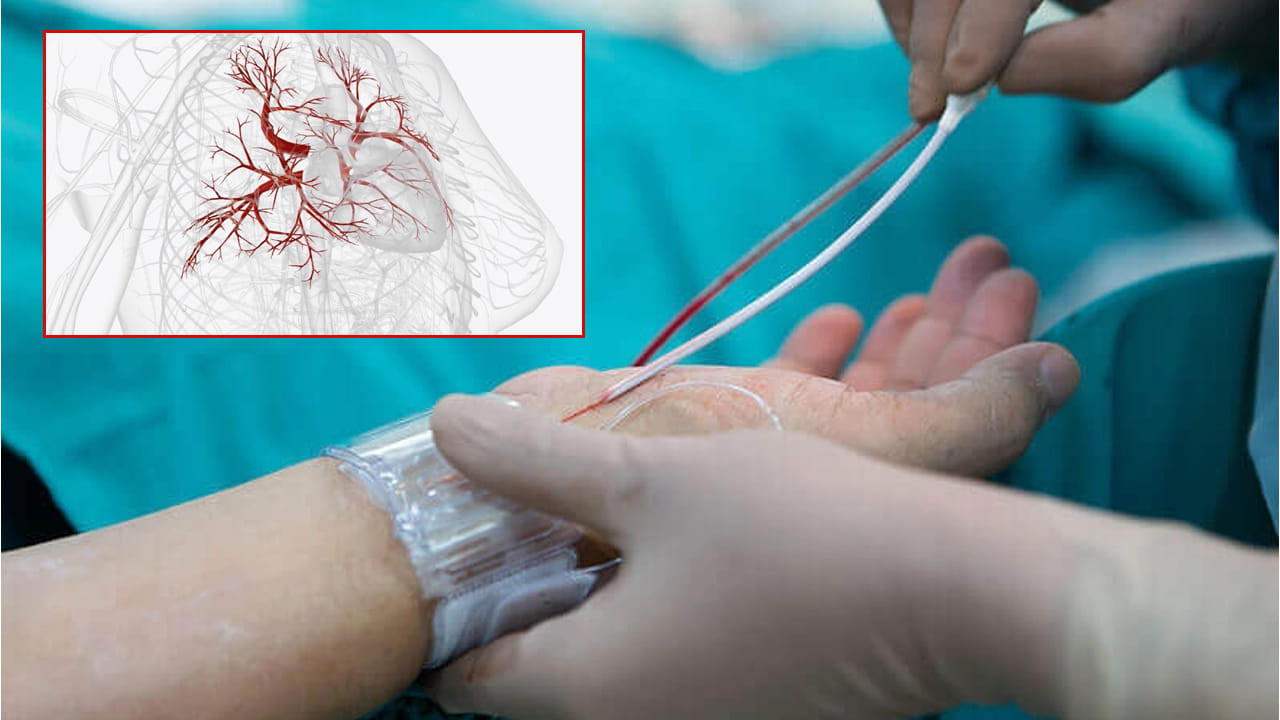 Angiogram: యాంజియోగ్రామ్ అంటే ఏంటి..? అసలు దీన్ని ఎందుకు చేస్తారు..? ఎలా చేస్తారు..?