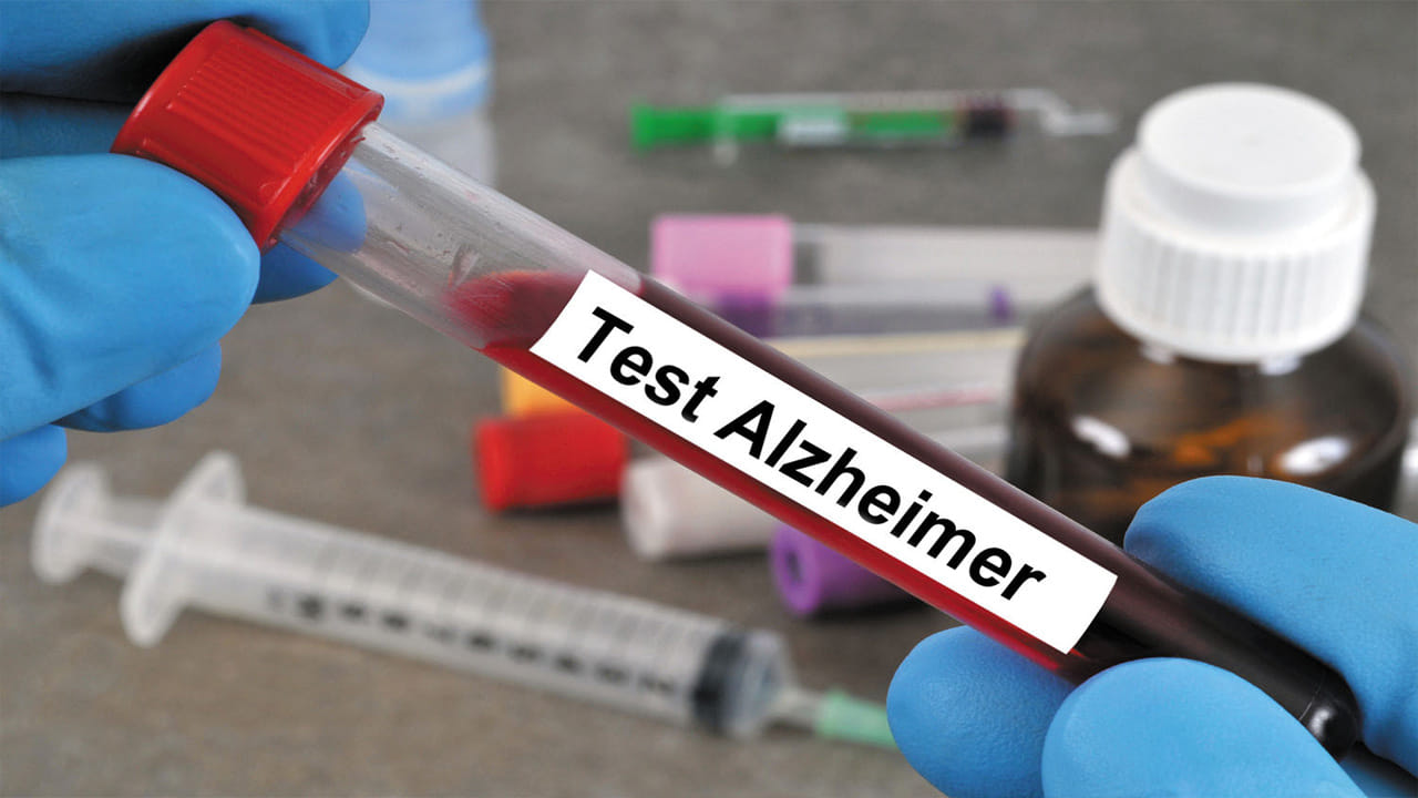 Alzheimers Diagnosis Test: సాధారణ రక్త పరీక్షతోనే అల్జీమర్స్‌కు చెక్.. ఇకపై మతిమరుపుకు ప్రారంభ దశలోనే చికిత్స!
