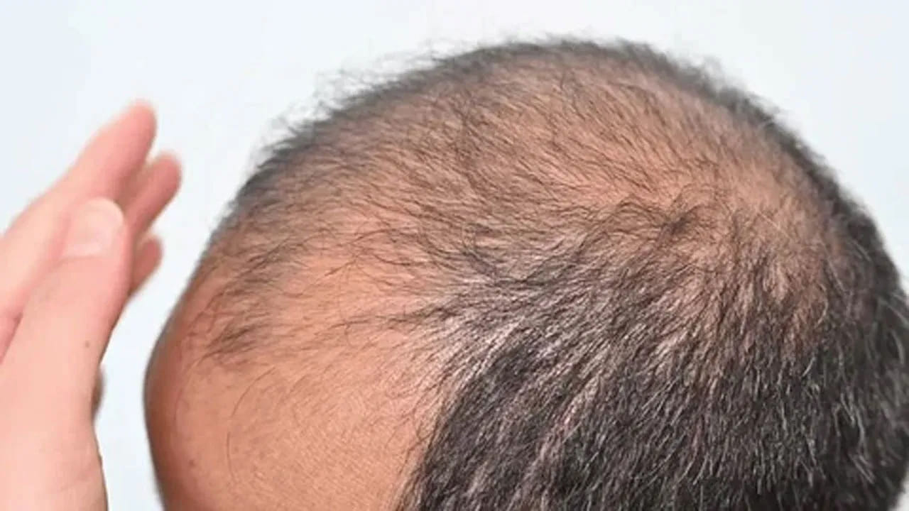 జుట్టు రాలడం అనేది ఒక వ్యాధి కాదు, అది మీ లోపల ఏదో లోపం ఉందని చెప్పే ఒక లక్షణం మాత్రమే. పెరుగు వంటి సహజ సిద్ధమైన ప్రోబయోటిక్స్ తీసుకోవడం ద్వారా పేగుల ఆరోగ్యాన్ని మెరుగుపరచుకోవాలి.
వేళకు భోజనం, సరిపడా నీరు తాగడం అలవాటు చేసుకోవాలి. కేవలం జుట్టుకు చికిత్స చేయించుకునే ముందు మీ జీర్ణక్రియ, హార్మోన్లు, ఒత్తిడి స్థాయిలను పరీక్షించుకోవడం ఉత్తమం.
