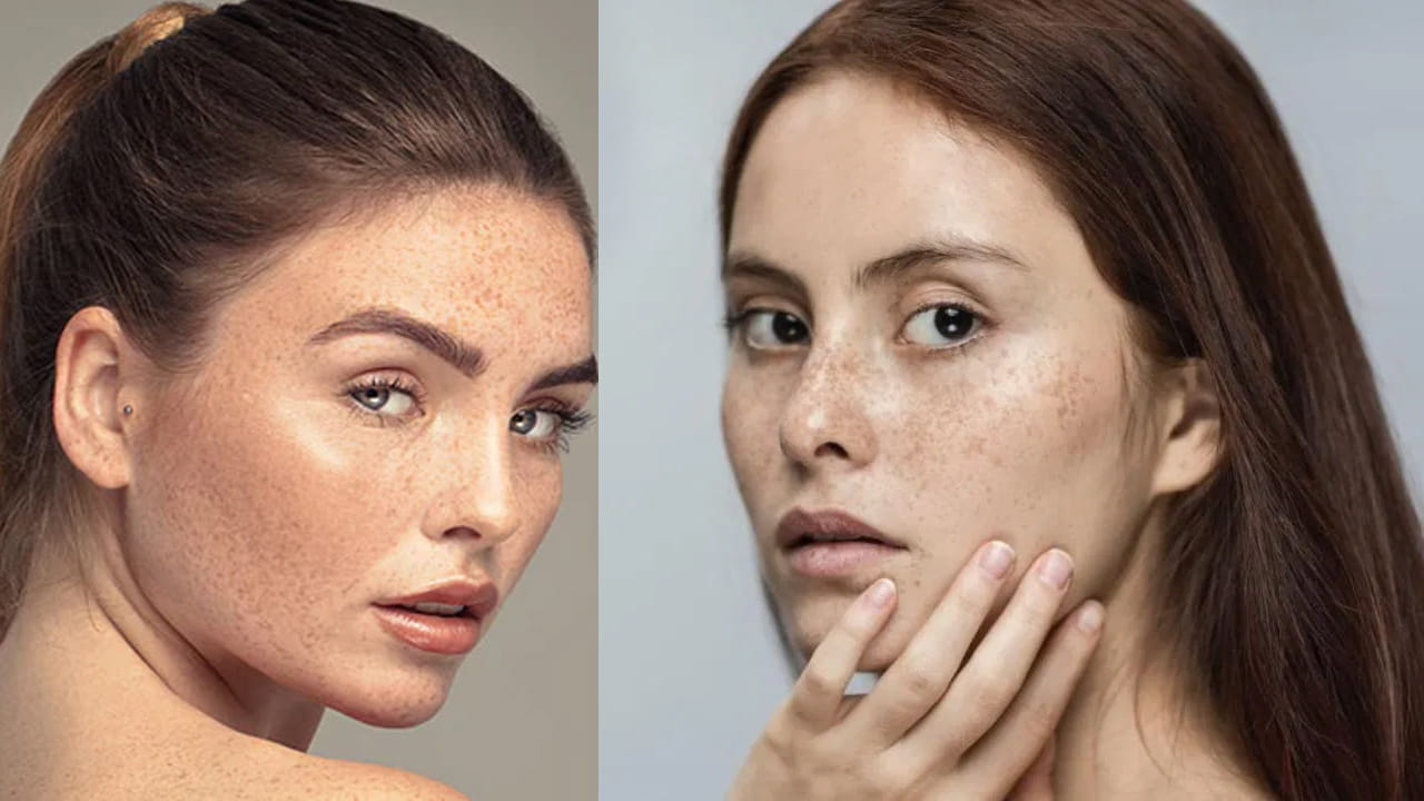 Dark Spots: ముఖం, చర్మంపై నల్లని మచ్చలు ఎందుకొస్తాయంటే..? ఈ టిప్స్ పాటిస్తే..