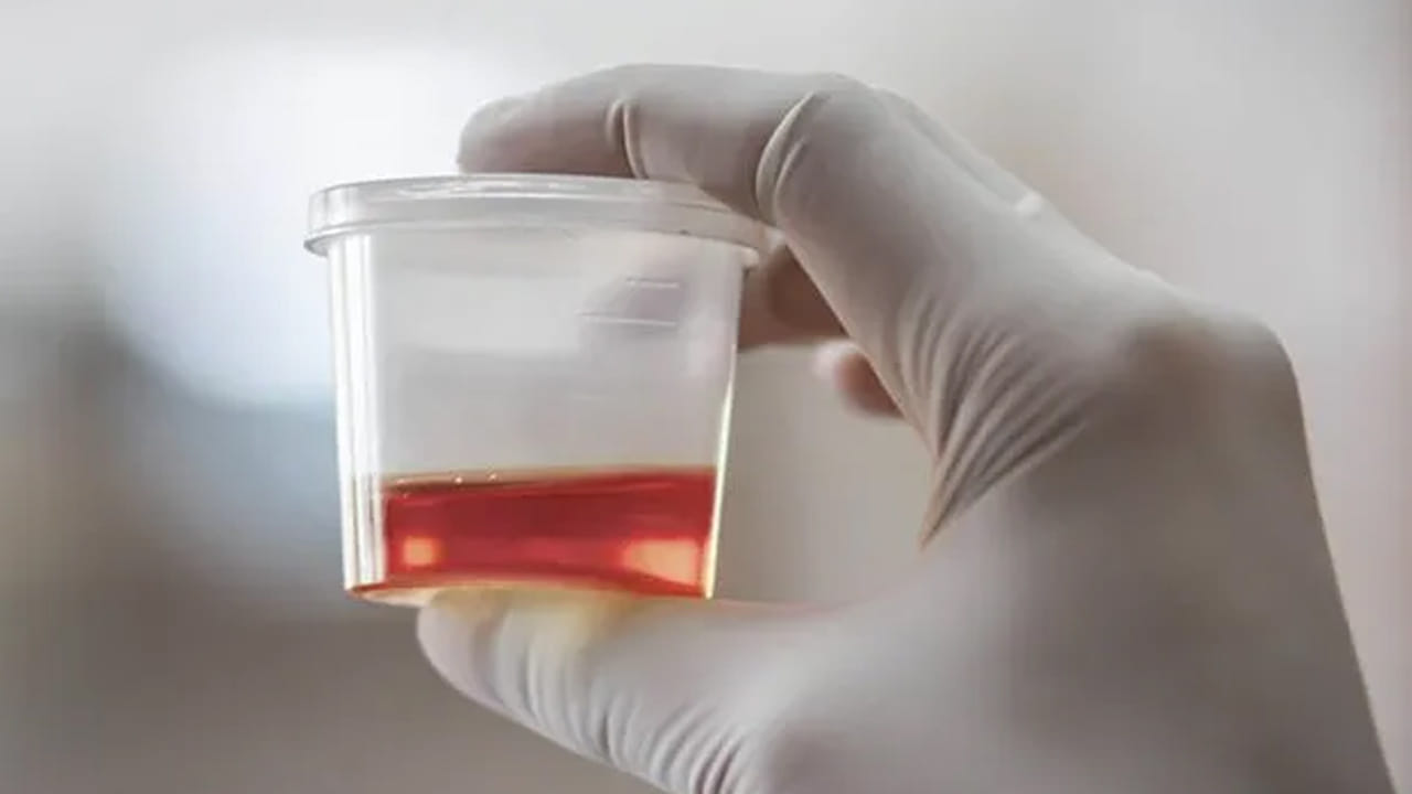 వామ్మో.. మూత్రంలో రక్తం కనిపించడం మూత్రపిండాల క్యాన్సర్‌కు సంకేతమా..?