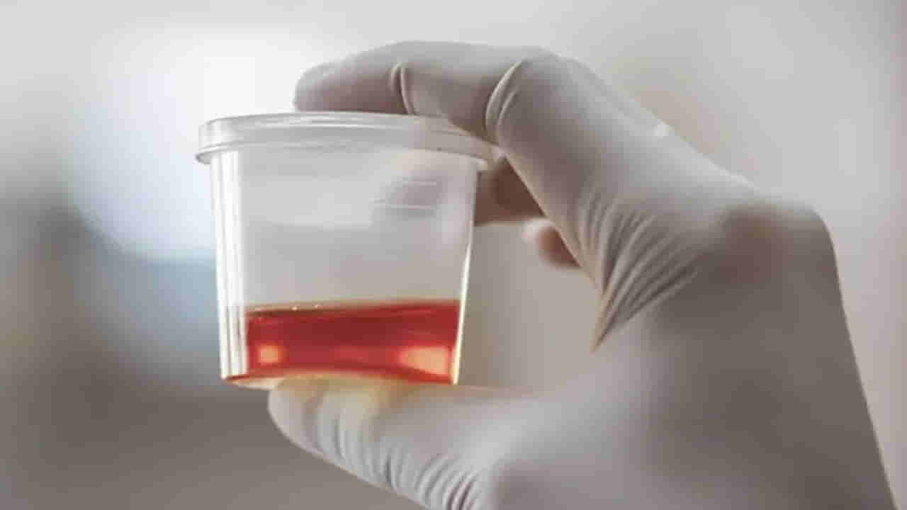వామ్మో.. మూత్రంలో రక్తం కనిపించడం మూత్రపిండాల క్యాన్సర్కు సంకేతమా..?