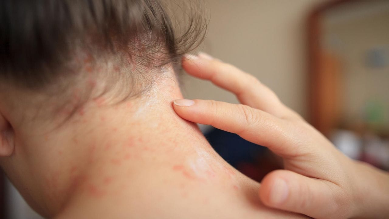 వేసవిలో పిల్లలతో జాగ్రత్త! చెమటకాయల టార్చర్, ఎర్రటి పొక్కులు, దురదకు చెక్ పెట్టే చిట్కాలు