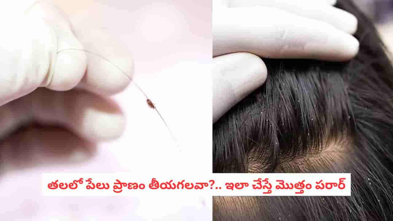 Head Lice: తలలో పేలను తక్కువ అంచనా వేయకండి.. 12 ఏళ్ల బాలిక ప్రాణాలను తీసిన నిర్లక్ష్యం!