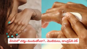 వేసవిలో మొటిమలు, చుండ్రుకు ఇలా చెక్ పెట్టండి!