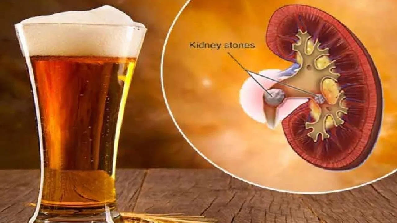 బీరు తాగితే కిడ్నీ రాళ్లు మాయం అనేది ఒక ప్రమాదకరమైన అపోహ. కిడ్నీ సమస్యలు ఉన్నవారు బీరుకు ఎంత దూరంగా ఉంటే అంత మంచిది. సొంత వైద్యం మానుకొని, నిపుణులైన యూరాలజిస్ట్‌ను సంప్రదించడమే ఉత్తమ మార్గం.
