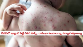 వేసవిలో ఇబ్బంది పెట్టే చికెన్ పాక్స్.. రాకుండా ఉండాలన్నా, వచ్చాక