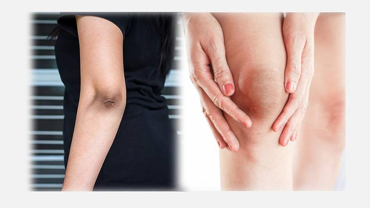  కొబ్బరి నూనె, నిమ్మరసం: కొబ్బరి నూనెలో కొద్దిగా నిమ్మరసం కలిపి ప్రతిరోజూ స్నానానికి ముందు మసాజ్ చేయాలి. కొబ్బరి నూనెలో ఉండే విటమిన్ ఇ చర్మాన్ని రిపేర్ చేస్తుంది. నలుపును క్రమంగా తగ్గిస్తుంది.
