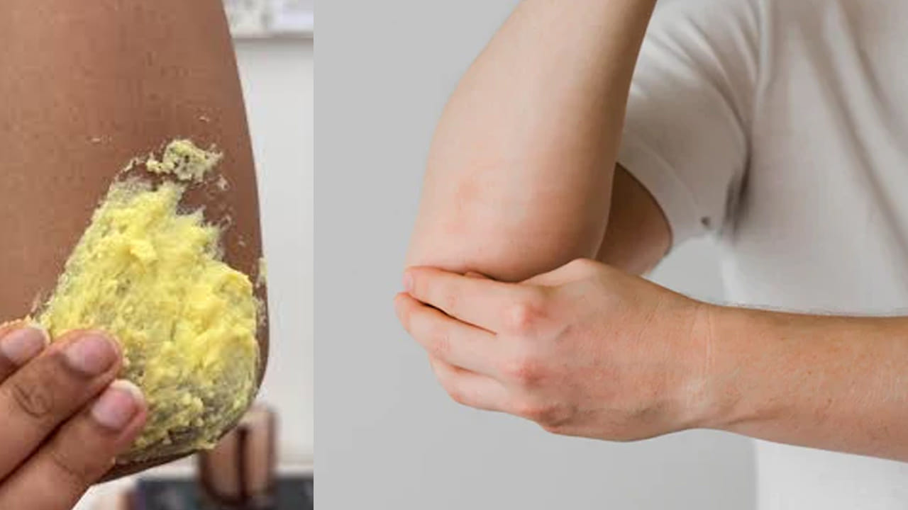  కలబంద, పాలు (Aloe Vera & Milk): కలబంద గుజ్జుకు కొంచెం పాలు కలిపి నల్లగా ఉన్న చోట రాయాలి. రాత్రంతా అలాగే ఉంచి ఉదయాన్నే కడిగేయాలి. కలబంద చర్మానికి తేమను ఇస్తుంది, పాలు చర్మం రంగును మెరుగుపరుస్తాయి.