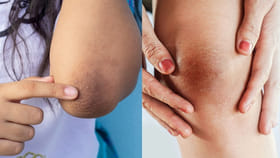 మోకాళ్లు, మోచేతుల దగ్గర నలుపు ఇబ్బంది పెడుతోందా? ఈ చిట్కాలతో