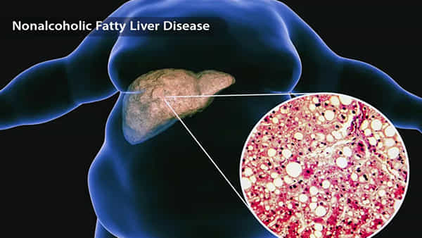 Fatty Liver: పిల్లల్లోనూ ఫ్యాటీ లివర్ సమస్యలు.. అసలు ఇది ఎందుకు వస్తుందో తెలుసా?