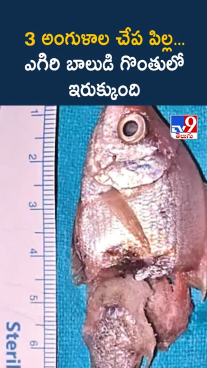 బాలుడి గొంతులో ఇరుక్కున్న 3 అంగుళాల చేపపిల్ల..