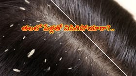 తలలో పేల సమస్యతో ఇబ్బంది పడుతున్నారా?ఇలా శాశ్వతంగా చెక్ పెట్టండి!