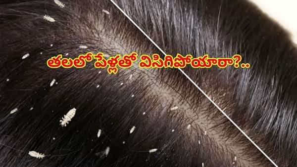 తలలో పేల సమస్యతో ఇబ్బంది పడుతున్నారా? ఈ 5 హోమ్ రెమెడీస్తో శాశ్వతంగా చెక్ పెట్టండి!