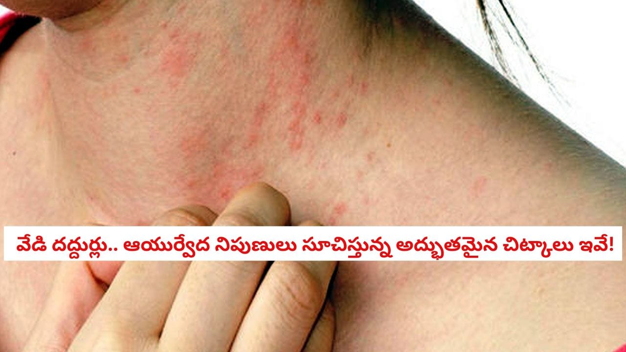 Skin Care: వేసవిలో వేడి దద్దుర్లు వచ్చే అవకాశం వీరికి ఎక్కువ.. ఈ మిశ్రమంతో సమస్యకు చెక్