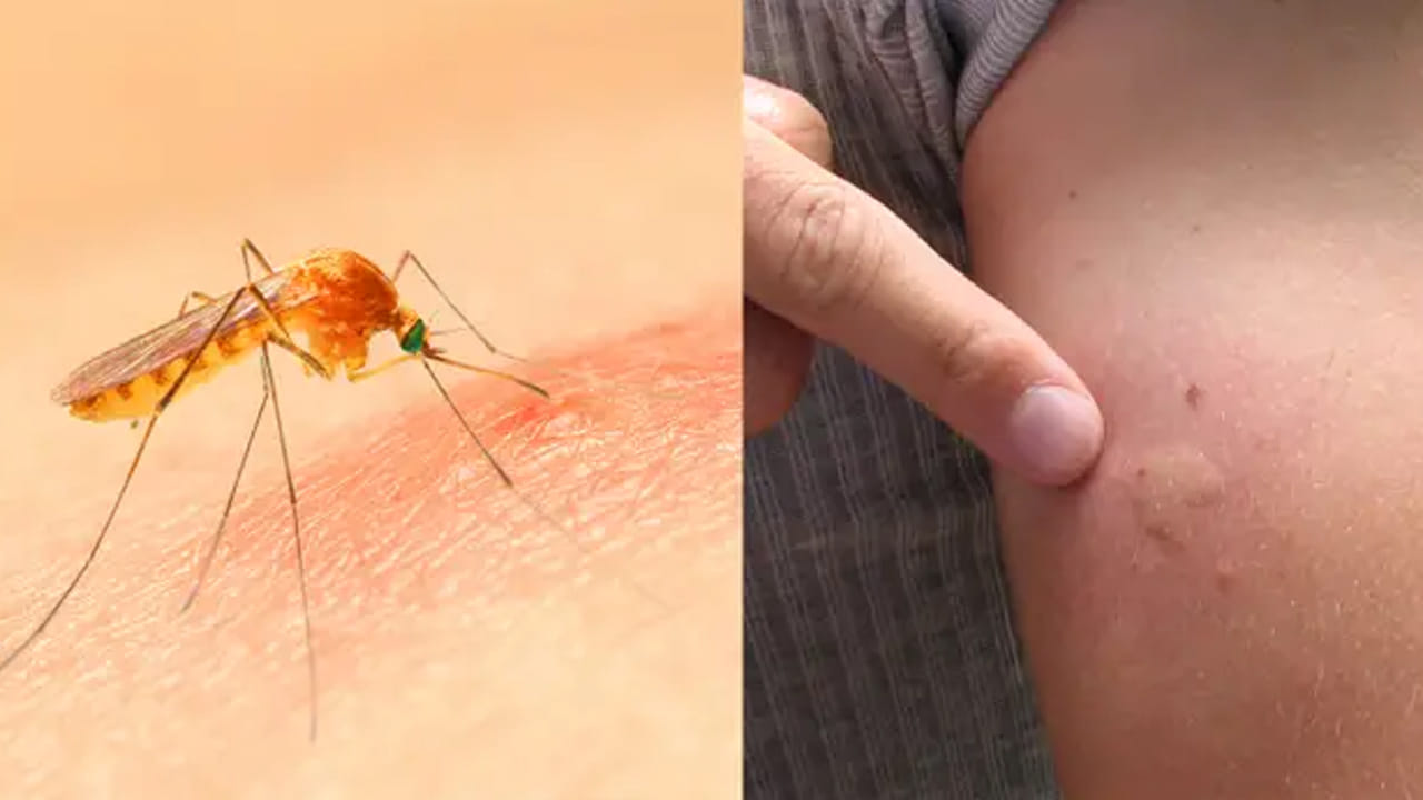 దోమల బారి నుండి తప్పించుకోవడం కేవలం సౌకర్యం కోసమే కాదు, ఆరోగ్యానికి కూడా చాలా ముఖ్యం. దోమలు కుట్టకుండా ఉండాలంటే లేత రంగు దుస్తులు ధరించడం ఒక మంచి పద్ధతి, ఎందుకంటే ముదురు రంగులు దోమలకు త్వరగా కనిపిస్తాయి. సాయంత్రం వేళల్లో బయట తిరిగేటప్పుడు శరీరం పూర్తిగా కప్పబడేలా దుస్తులు వేసుకోవాలి. ఇంట్లోకి దోమలు రాకుండా నెట్స్ ఉపయోగించడం, నిల్వ ఉన్న నీటిని తొలగించడం వంటివి చేయాలి. వేప నూనె లేదా ఇతర సహజమైన దోమల వికర్షకాలను వాడటం ద్వారా కూడా మనం సురక్షితంగా ఉండవచ్చు. చిన్నపాటి జాగ్రత్తలు పాటిస్తే ప్రమాదకరమైన రోగాల నుండి మనల్ని మనం కాపాడుకోవచ్చు.