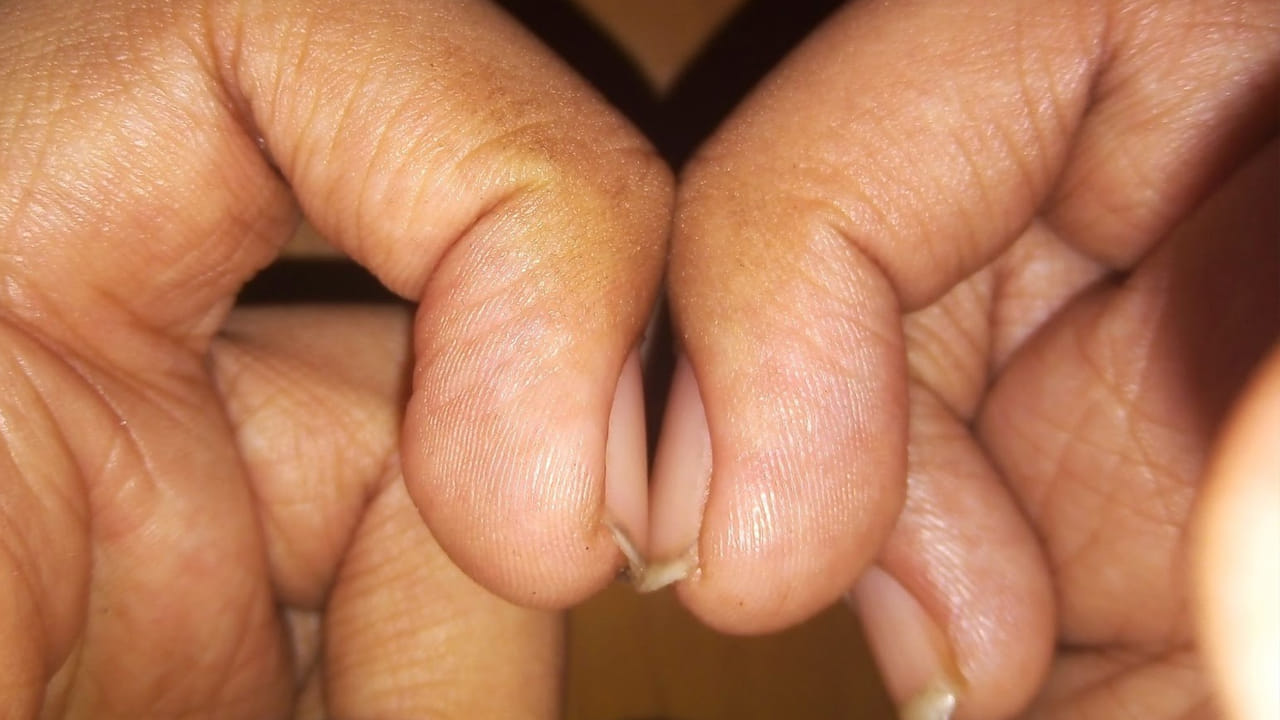 గోళ్లలో దాగిన క్యాన్సర్ రహస్యం.. ఇలా ఉంటే జాగ్రత్త..