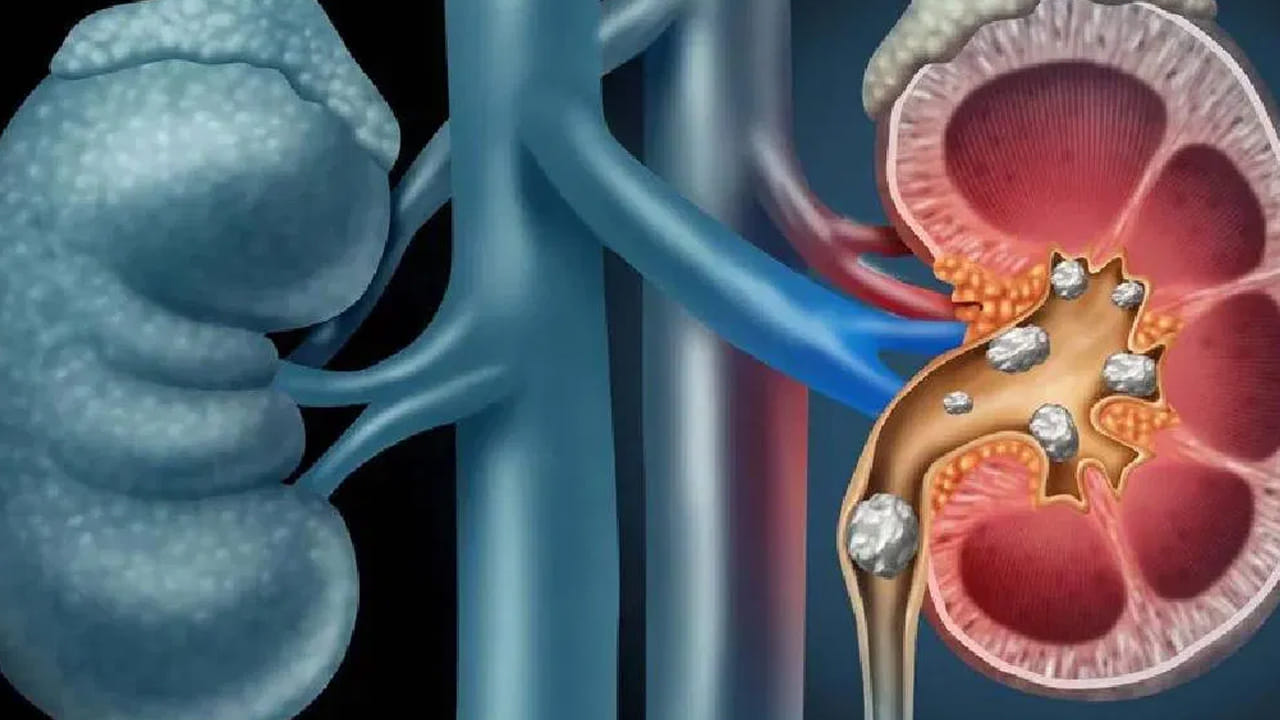 (NOTE: ఇందులోని అంశాలు కేవలం అవగాహన కోసం మాత్రమే. నిపుణులు అందించిన సమాచారం ప్రకారం ఇక్కడ తెలియజేయడమైనది. ఆరోగ్యరీత్యా ఎలాంటి సమస్యలు ఉన్నానేరుగా వైద్య నిపుణులను సంప్రదించడం మంచిది)