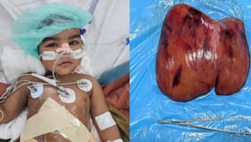 ఉస్మానియా వైద్యుల అరుదైన లివర్ ట్రాన్సప్లాంటేషన్ ఆపరేషన్