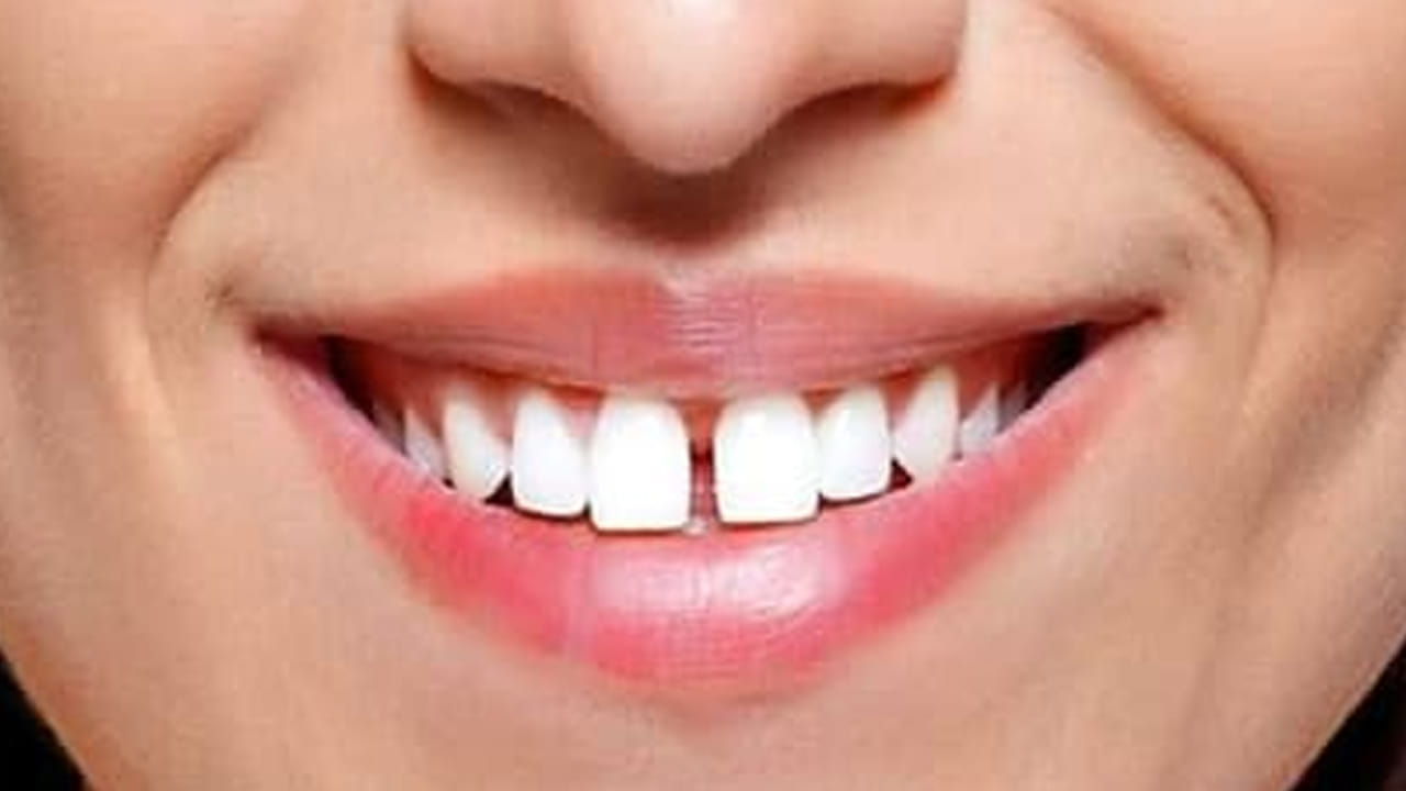 పళ్ల మధ్య గ్యాప్ ఎక్కువగా ఉన్నవారు, తమ జీవితంలో కాస్త ఆలస్యమైనా సరే తప్పకుండా విజయం సాధిస్తారంట. అంతే కాకుండా అనుకోని విధంగా వీరిని అదృష్టం వెంటాడుతుంది. వీరు చాలా వరకు సౌమ్యులుగా కనిపిస్తారు, కానీ వీరు మహా మేధావులు.