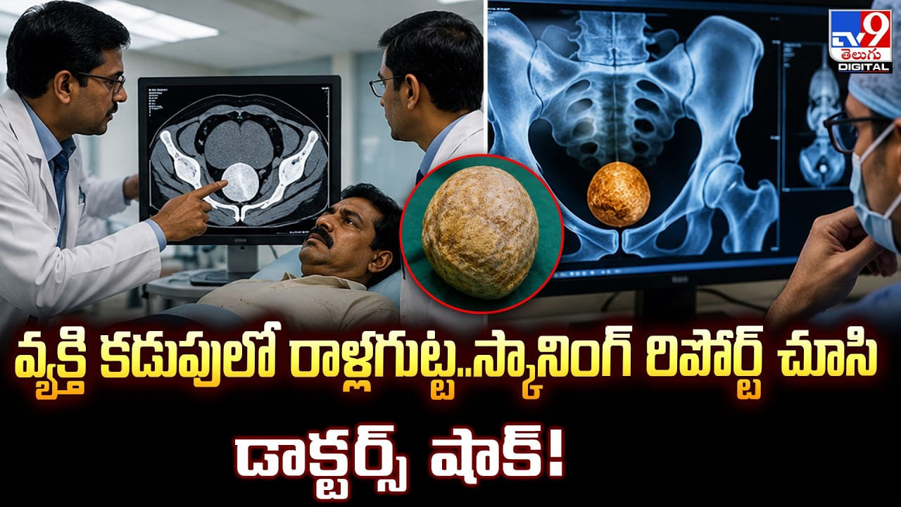 వ్యక్తి కడుపులో రాళ్లగుట్ట..స్కానింగ్‌ రిపోర్ట్‌ చూసి డాక్టర్స్‌ షాక్‌!