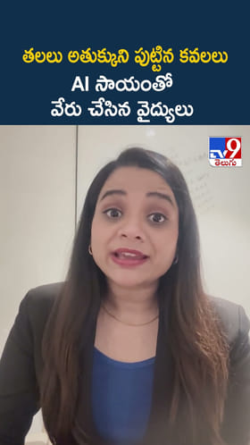 తలలు అతుక్కుని పుట్టిన కవలలు.. AI సాయంతో వేరు చేసిన వైద్యులు