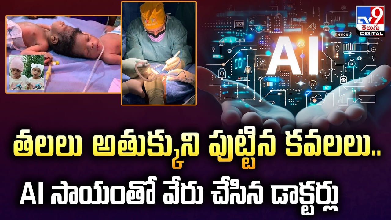 తలలు అతుక్కుని పుట్టిన కవలలు.. AI సాయంతో వేరు చేసిన డాక్టర్లు