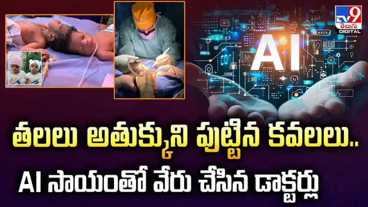 తలలు అతుక్కుని పుట్టిన కవలలు.. AI సాయంతో వేరు చేసిన డాక్టర్లు తలలు అతుక్కుని పుట్టిన కవలలు.. AI సాయంతో వేరు చేసిన డాక్టర్లు