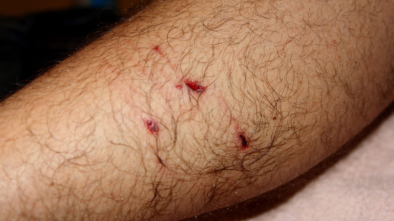 Dog Bite: కుక్క కరిచిన వెనువెంటనే చేయాల్సిన పనులు ఇవే..