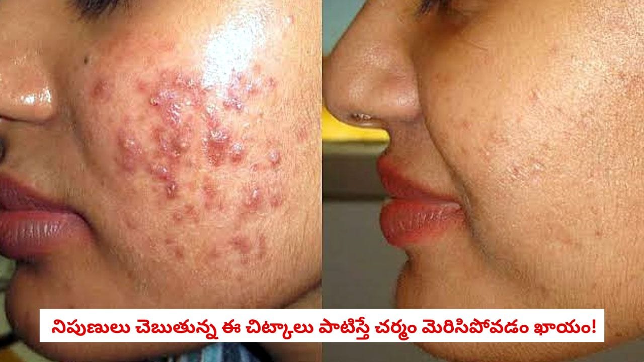 Hormonal Acne: ముఖంపై ఒకే చోట పదేపదే మొటిమలు వస్తున్నాయా.. ఖరీదైన క్రీములు వాడినా తగ్గకపోవడానికి అసలు కారణం ఇదే!