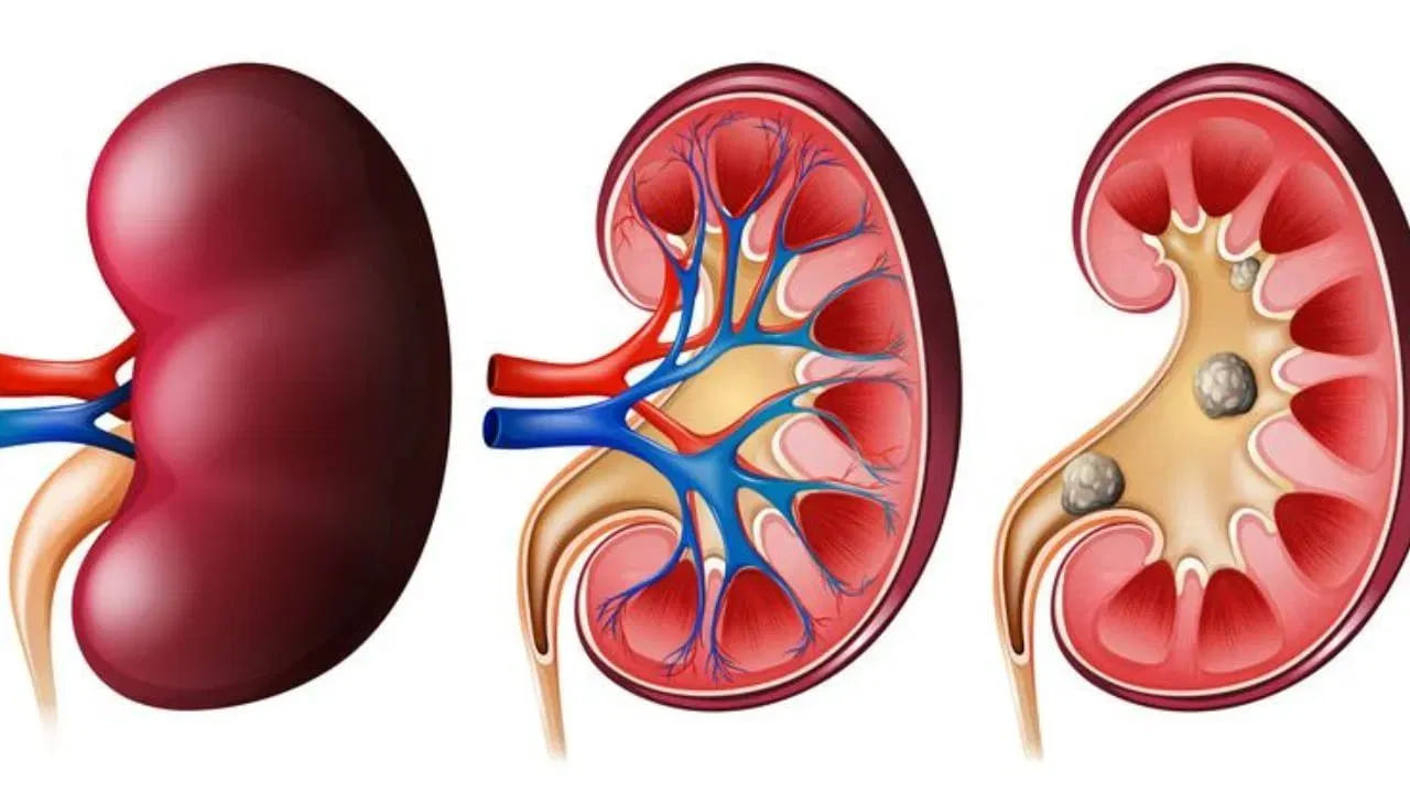  Kidney Stones Symptoms: ఈ రోజుల్లో చెడు జీవనశైలి, శరీరంలో నీటి కొరత, అనారోగ్యకరమైన ఆహారం ఆరోగ్యంపై చెడు ప్రభావాన్ని చూపుతాయి. ముఖ్యంగా మూత్రపిండాల్లో రాళ్ల ప్రమాదం కూడా చాలా పెరుగుతుంది. ఈ రోజుల్లో ఈ సమస్య చాలా తరచుగా కనిపిస్తోంది. మొదట్లో మూత్రపిండాలలో ఏర్పడిన చిన్న రాళ్లు ఎటువంటి ప్రత్యేక లక్షణాలను చూపించవు. కానీ అవి పెరిగేకొద్దీ, అనేక ప్రధాన లక్షణాలు కనిపించడం మొదలవుతాయి. 