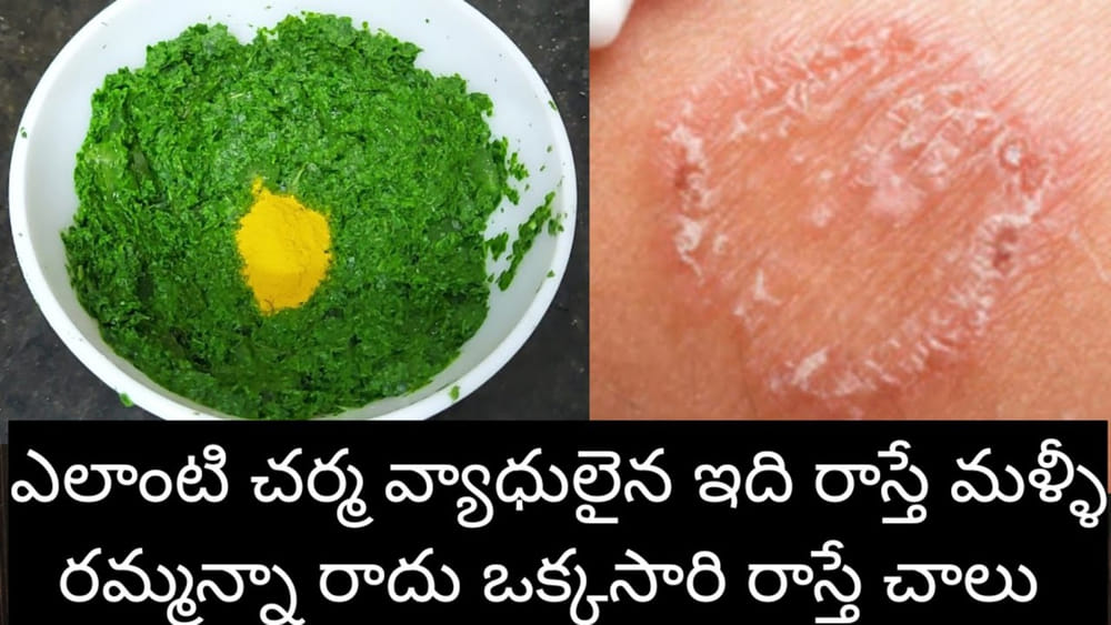 Ringworm: గజ్జి, దురద, తామర.. ఎలాంటి చర్మ వ్యాధికైనా ఒక్కసారి ఇది రాస్తేనా..