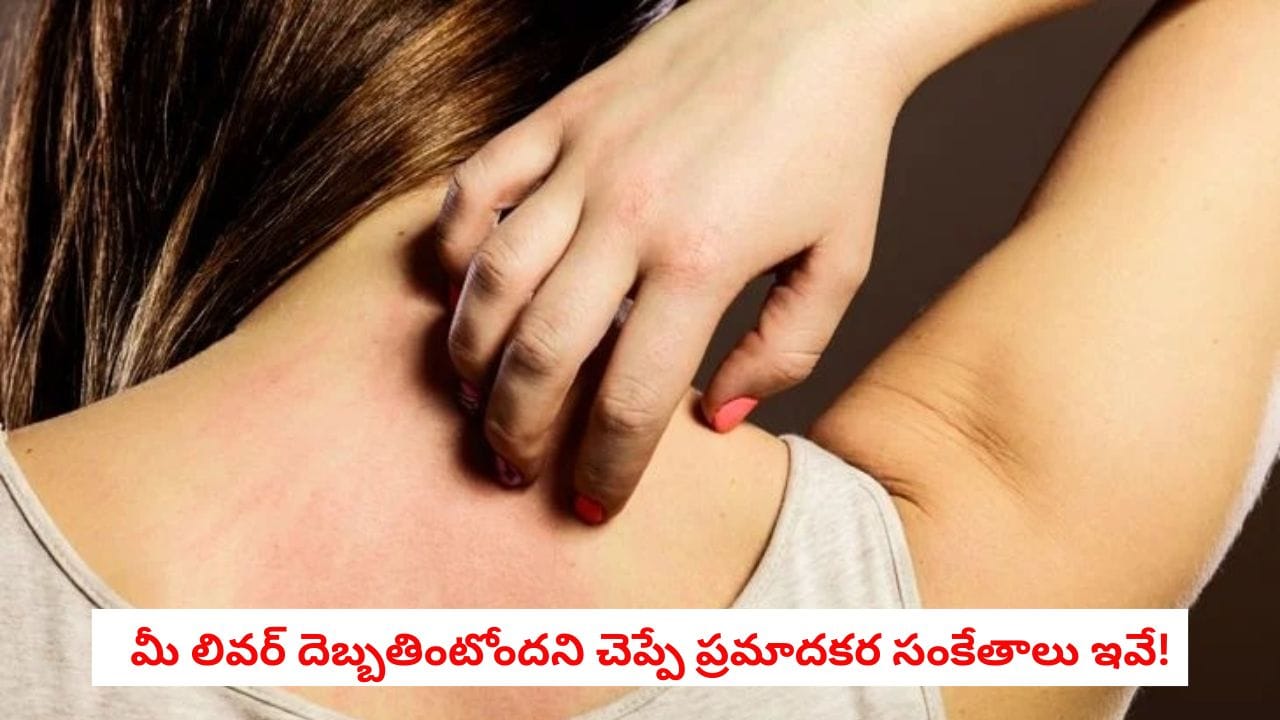 Liver Health: మీ చర్మంపై ఈ మార్పులు కనిపిస్తున్నాయా?.. లివర్ దెబ్బతింటోందని చెప్పే ప్రమాదకర సంకేతాలు ఇవే!